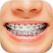 Braces 1.10.8